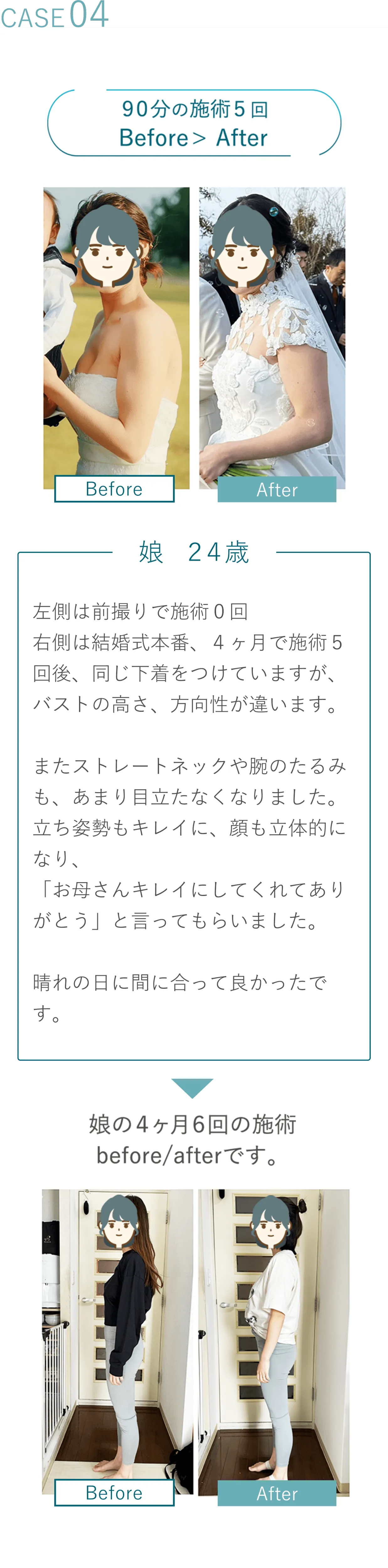 Case04 90分の施術5回 Before写真 > After写真 娘 24歳 左側は前撮りで施術０回 右側は結婚式本番、４ヶ月で施術５回後、同じ下着をつけていますが、バストの高さ、方向性が違います。またストレートネックや腕のたるみも、あまり目立たなくなりました。立ち姿勢もキレイに、顔も立体的になり、「お母さんキレイにしてくれてありがとう」と言ってもらいました。晴れの日に間に合って良かったです。 娘の４ヶ月６回の施術before/afterです。before写真 after写真